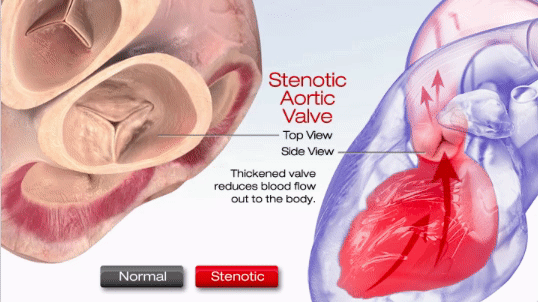 Аortic stenosis illustration